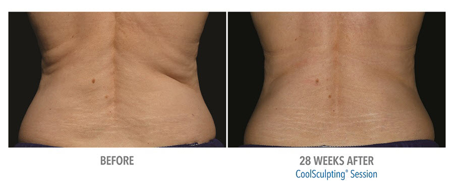 CoolSculpting to lower back. Before and after taken 28 weeks apart