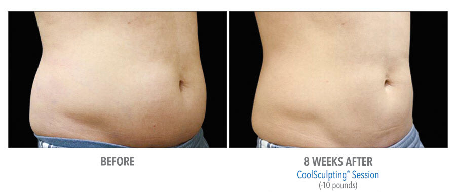 CoolSculpting to belly. Before and after taken 8 weeks apart. Patient lost 10 pounds