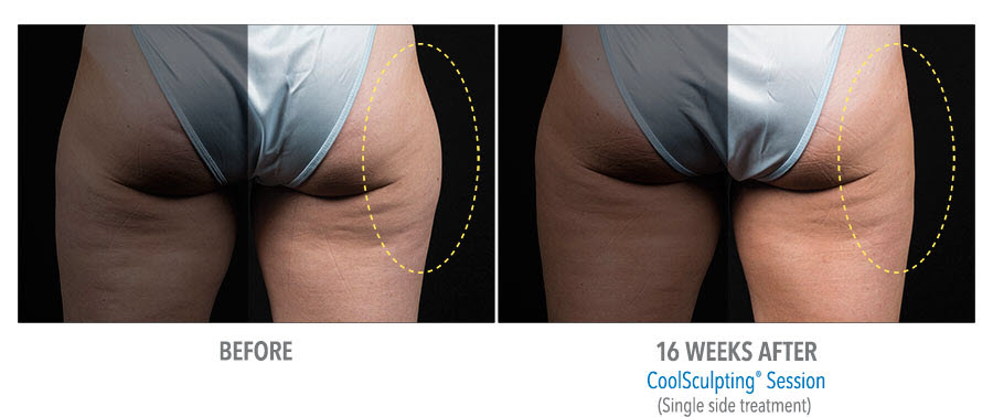 CoolSculpting to buttocks. Before and after taken 16 weeks apart. Single side treatment on the right